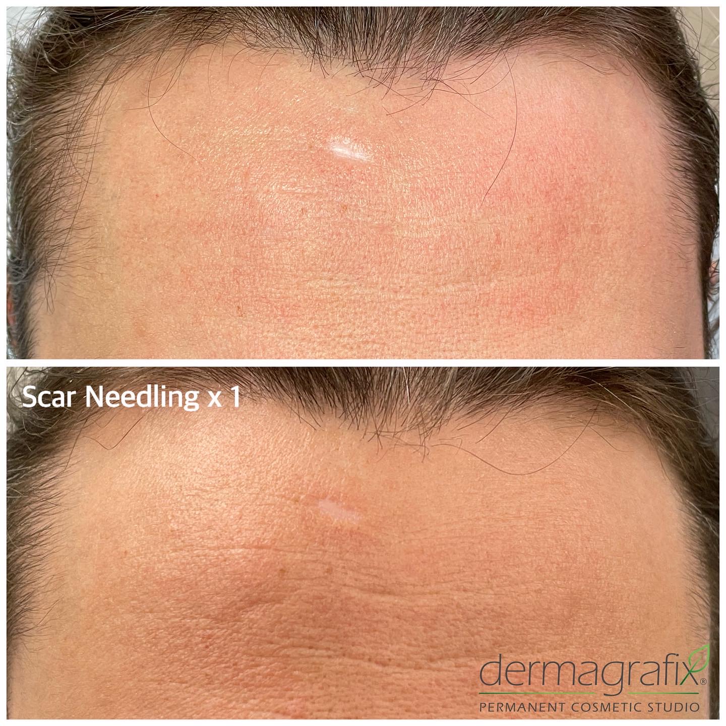 Forehead scar before and after a single ink-less scar needling session, with softened texture and reduced shadow