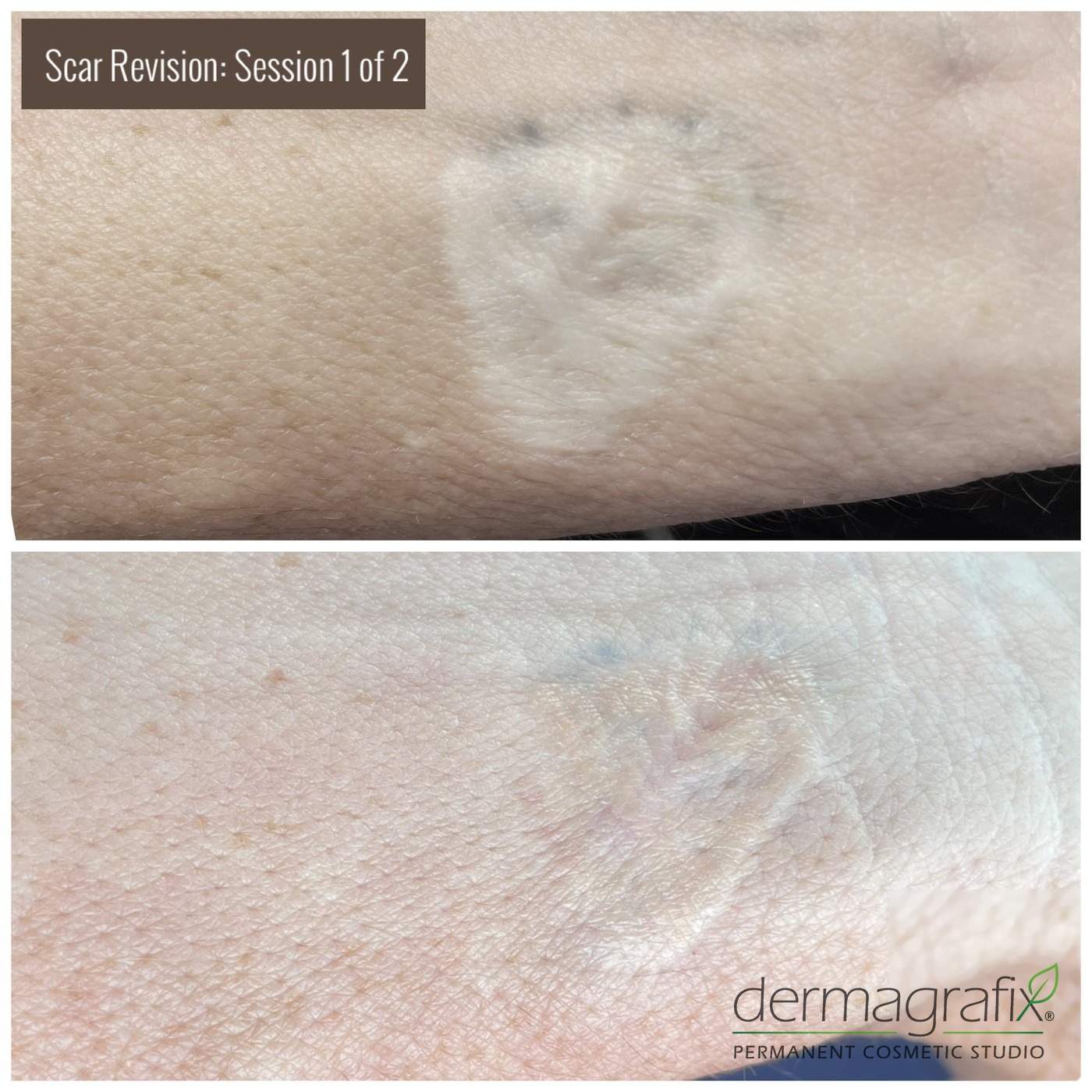 Raised forearm scar before and after the first session of scar re-pigmentation tattooing