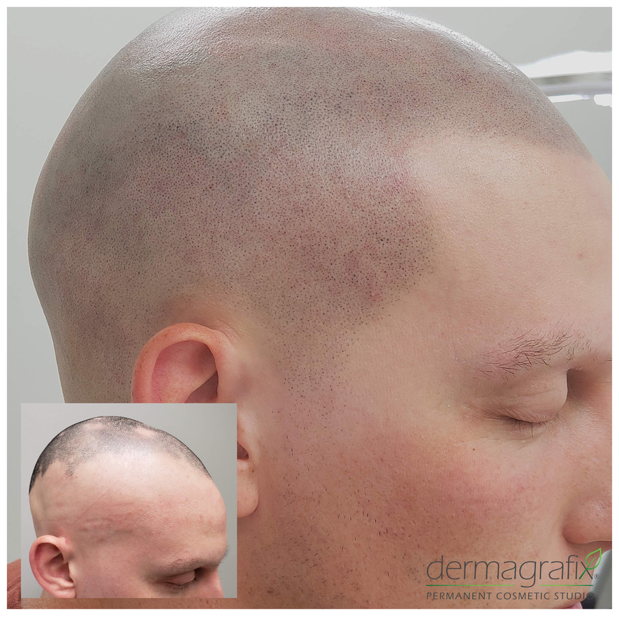 Scalp micropigmentation restoring a full hairline and coverage for advanced alopecia