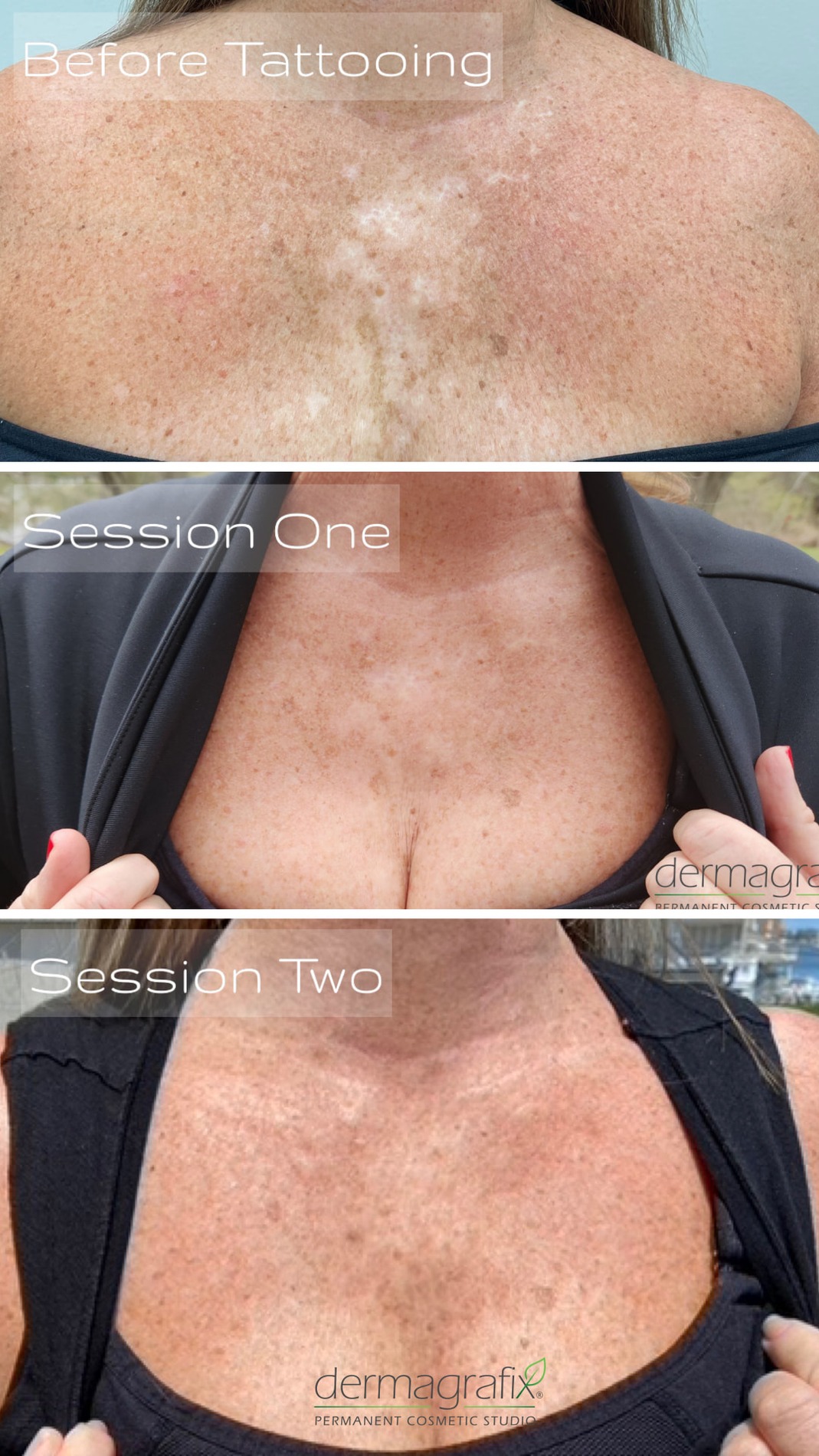 Pigment loss across the chest and décolleté shown before tattooing, after session one, and after session two of skin re-pigmentation matched to the surrounding freckled skin tone