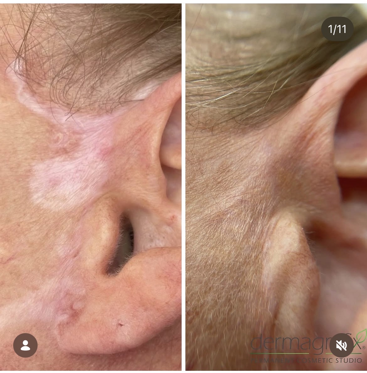 Facial scar at the temple and cheek before and after camouflage tattooing