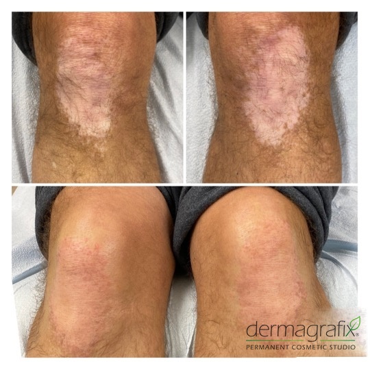 Vitiligo patch on a knee before and after skin re-pigmentation tattooing, blended into the surrounding skin tone