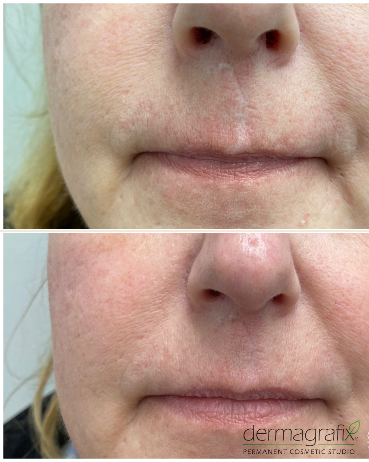 Perioral and upper lip area before and after ink-less scar revision, with softened lines and more even skin tone