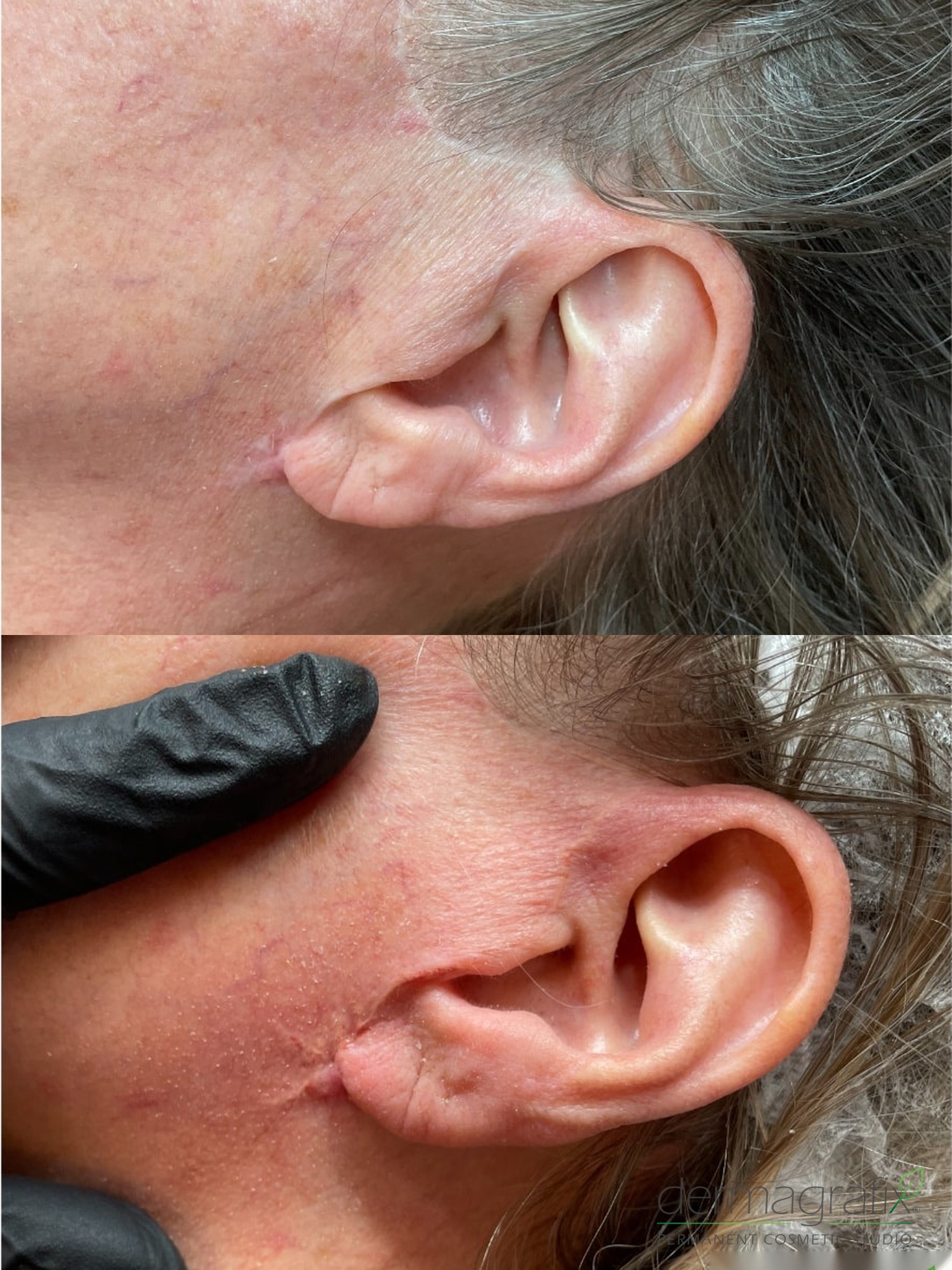 Facelift incision scar in front of and behind the ear before and after scar camouflage tattooing