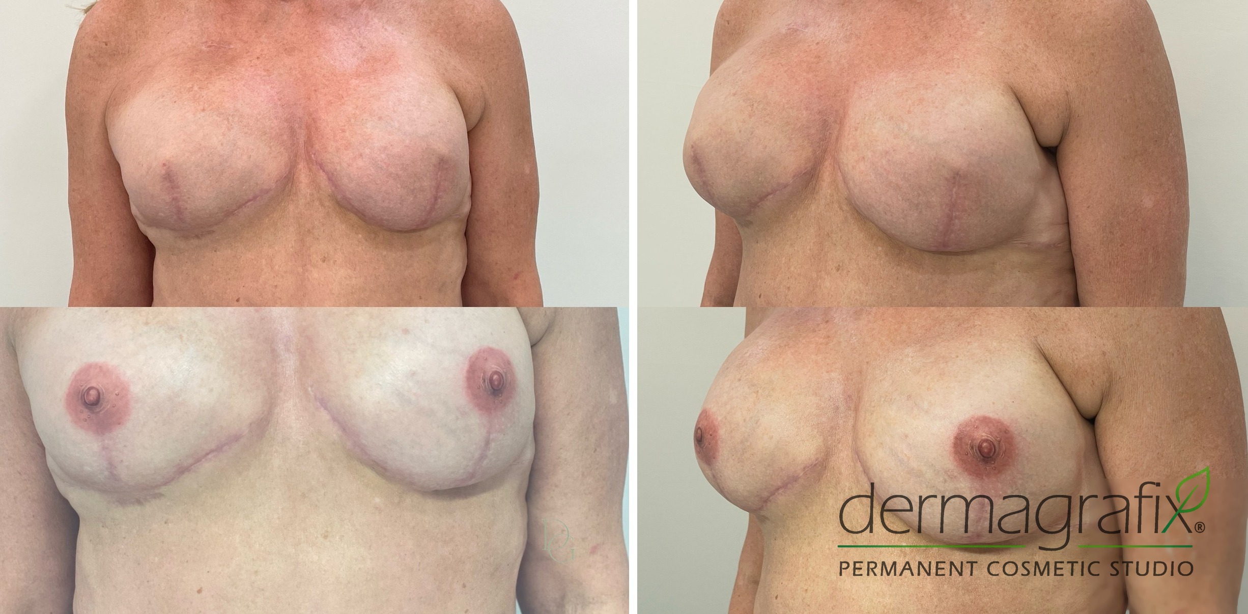 Bilateral mastectomy reconstruction before and after areola and nipple restoration tattooing, shown front-on and at an oblique angle