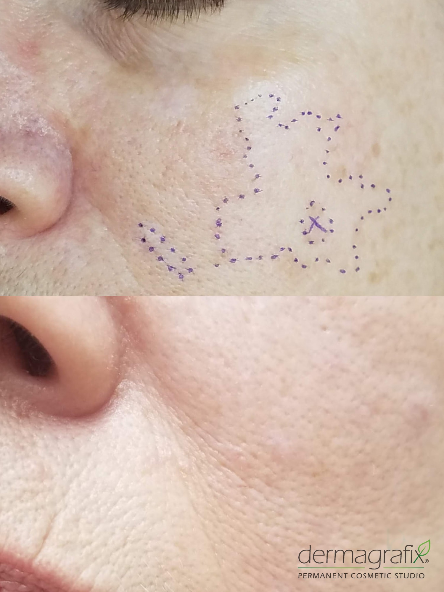 Cheek scar mapped for treatment and shown after skin re-pigmentation tattooing
