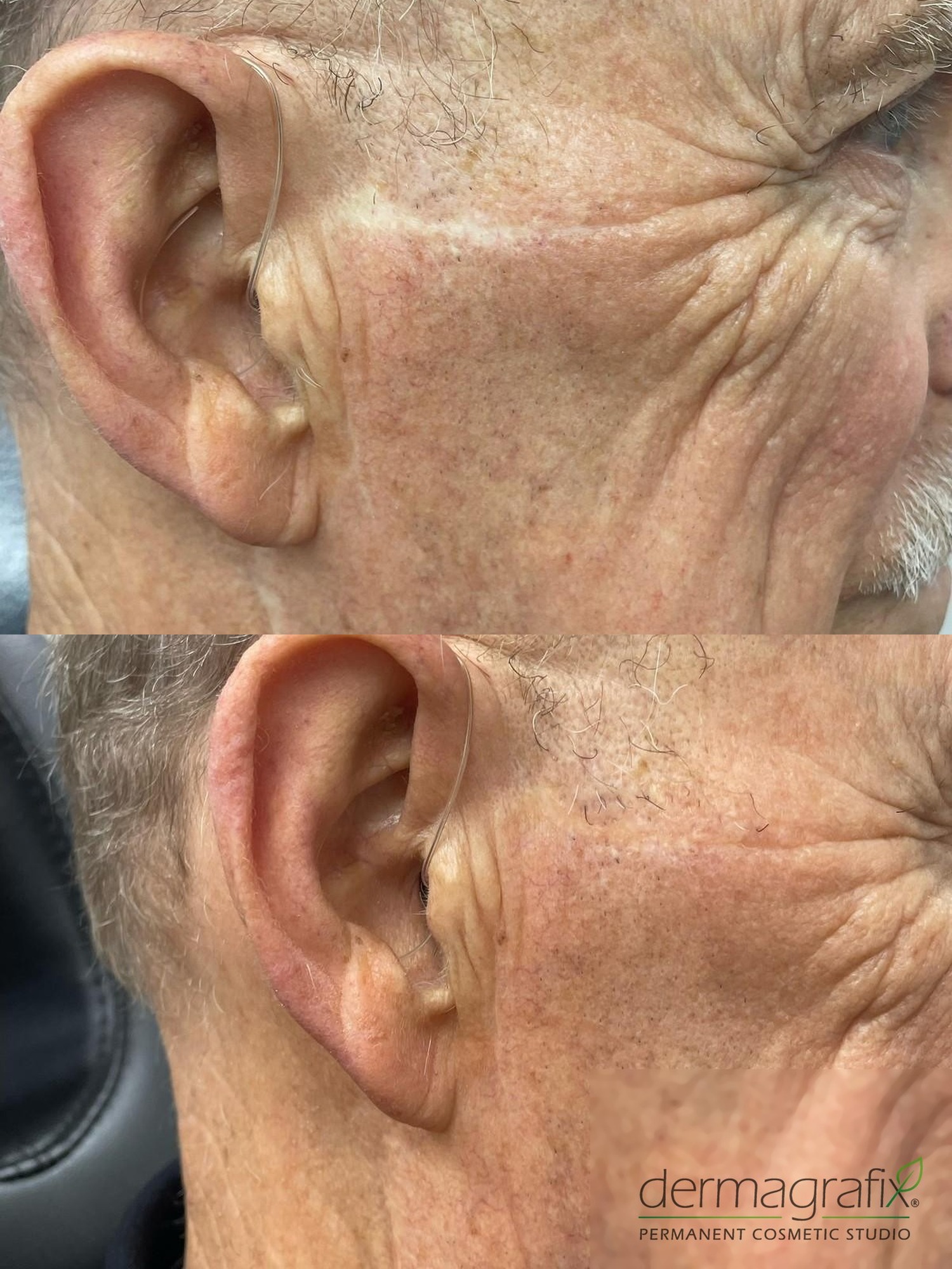 Scarring in front of the ear and temple before and after skin re-pigmentation tattooing