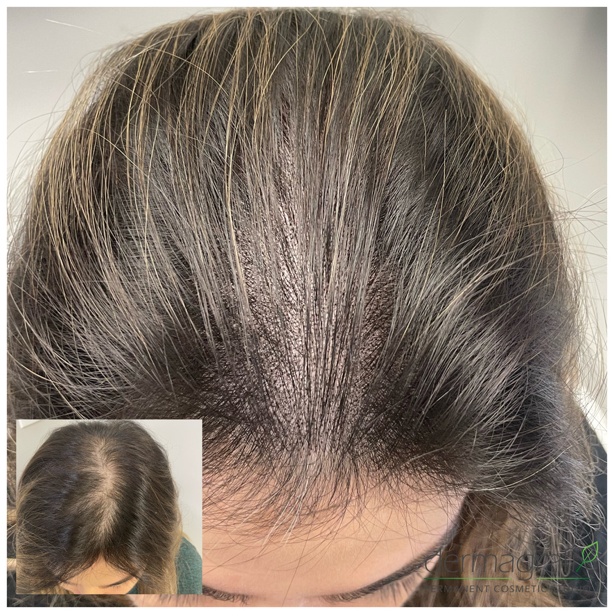 Scalp micropigmentation adding density along a widened part line for a woman with dark hair