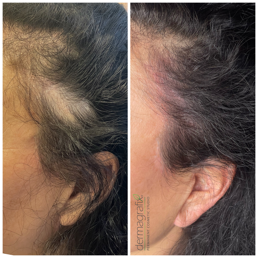 Scalp micropigmentation camouflaging alopecia areata patches along the temple and hairline