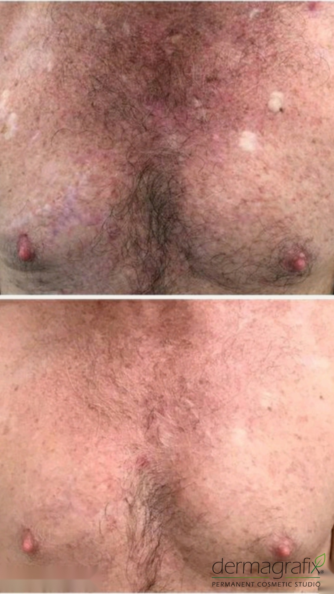 Male chest with scattered areas of pigment loss and redness shown before treatment, above the same chest after camouflage tattooing blended evenly into the surrounding skin tone