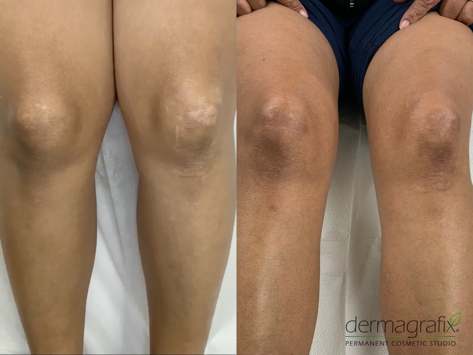 Raised, discoloured scarring across both knees before and after scar camouflage tattooing, blended into the surrounding skin tone