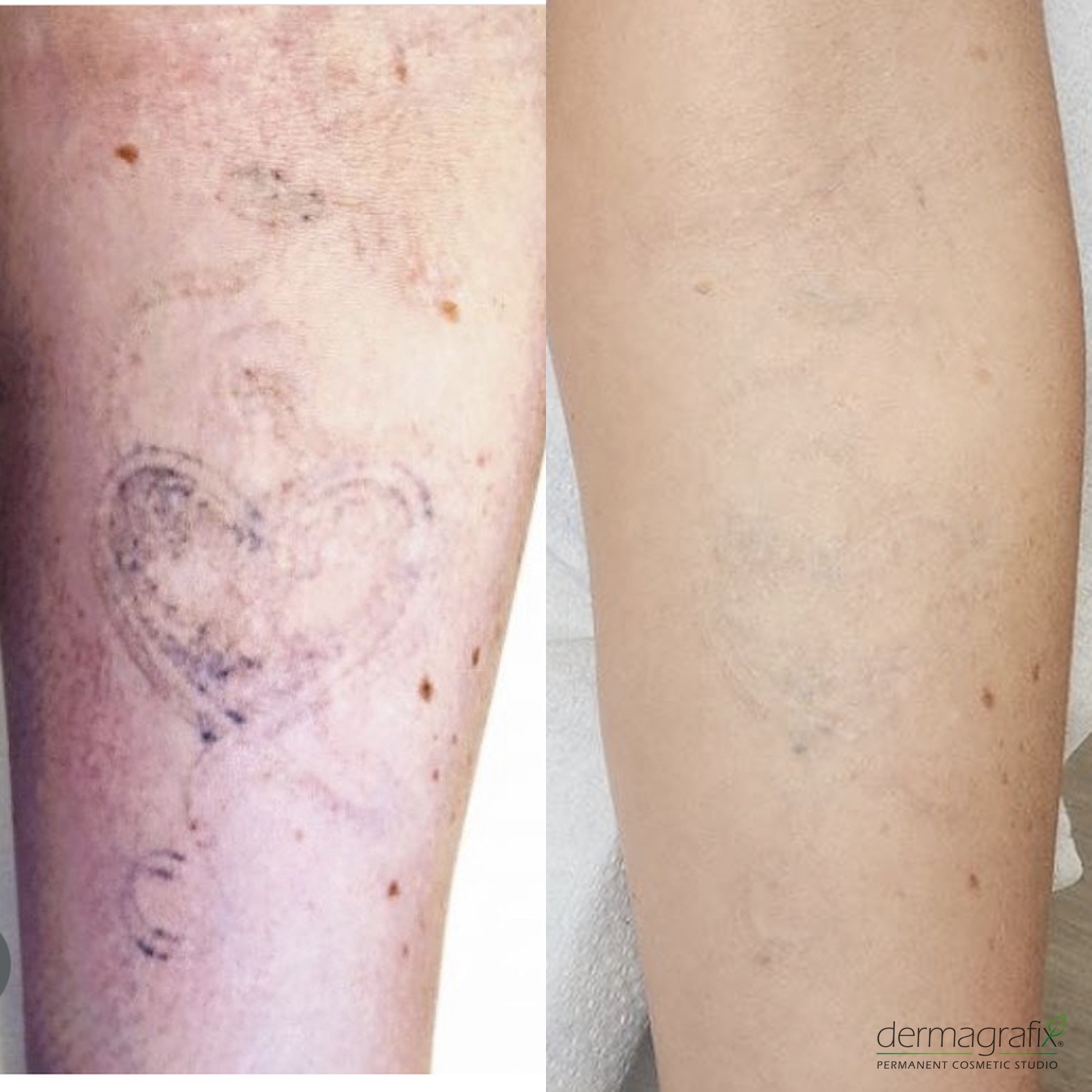 Forearm body tattoo before and after LiFT tattoo removal, showing the old ink significantly lifted post-laser