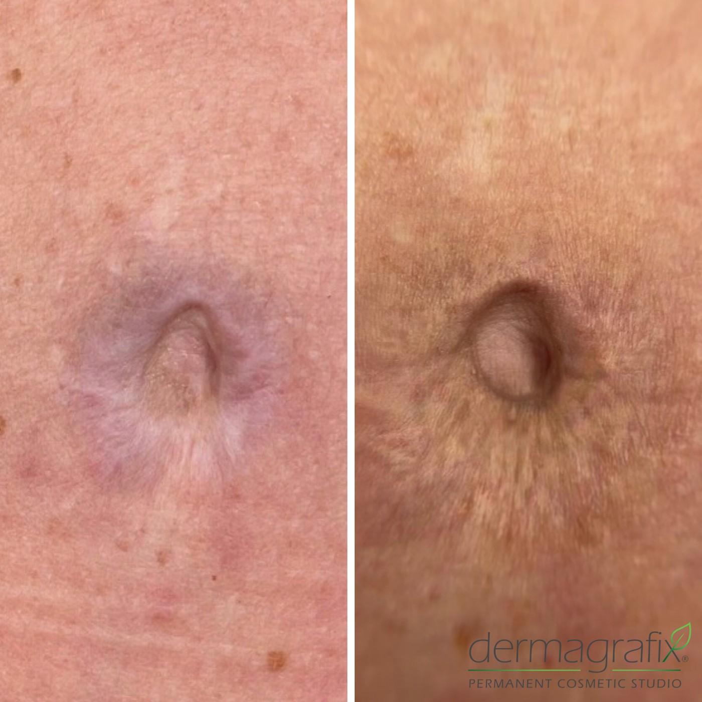 Localised scar before and after scar re-pigmentation tattooing