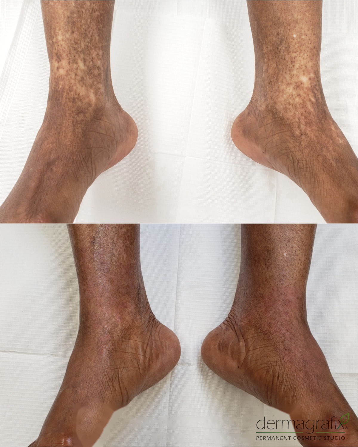 Hypo-pigmentation across both ankles and lower legs shown before tattooing and with camouflage re-pigmentation in progress, matched to the surrounding skin tone